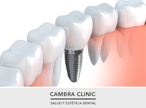 5 mitos sobre los implantes dentales